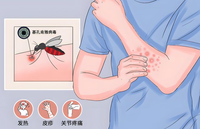 预防基孔肯雅热从防蚊灭蚊开始